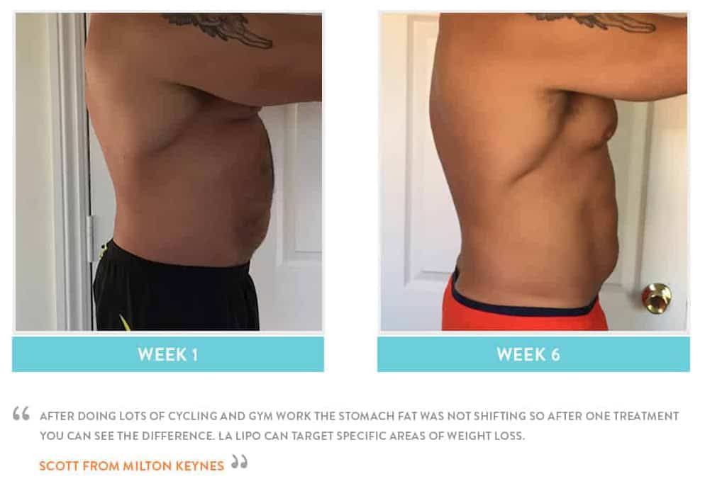 Before & After Stomach Fat Gloucester