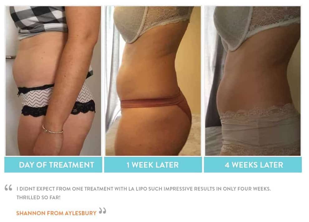 before, Cryolipolysis Gloucester