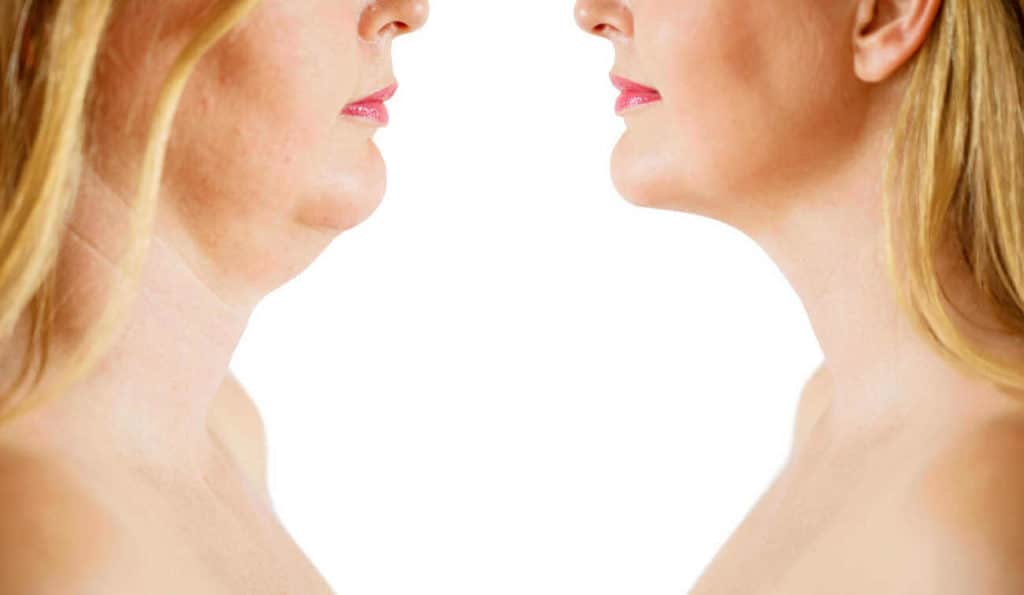 Double Chin treatment Gloucester before and after results