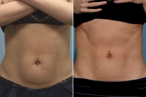 body sculpting FAQs Gloucester