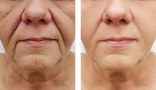 Learn more about Morpheus8 Treatment Gloucester today!