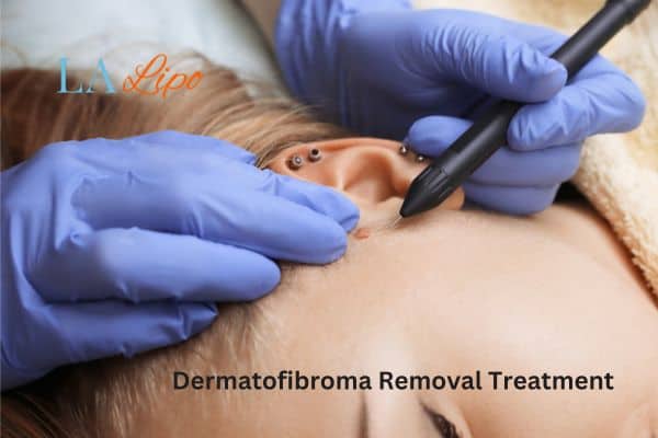Dermatofibroma Removal Treatment Gloucester