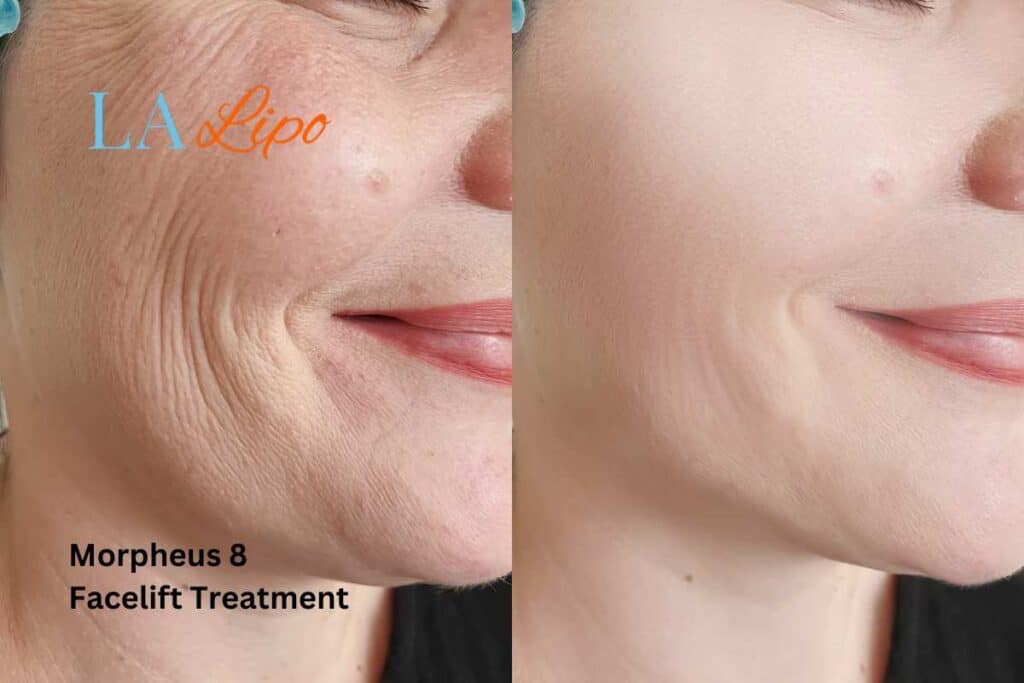 Morpheus8 Treatment Gloucester for flawless skin! Call us today!