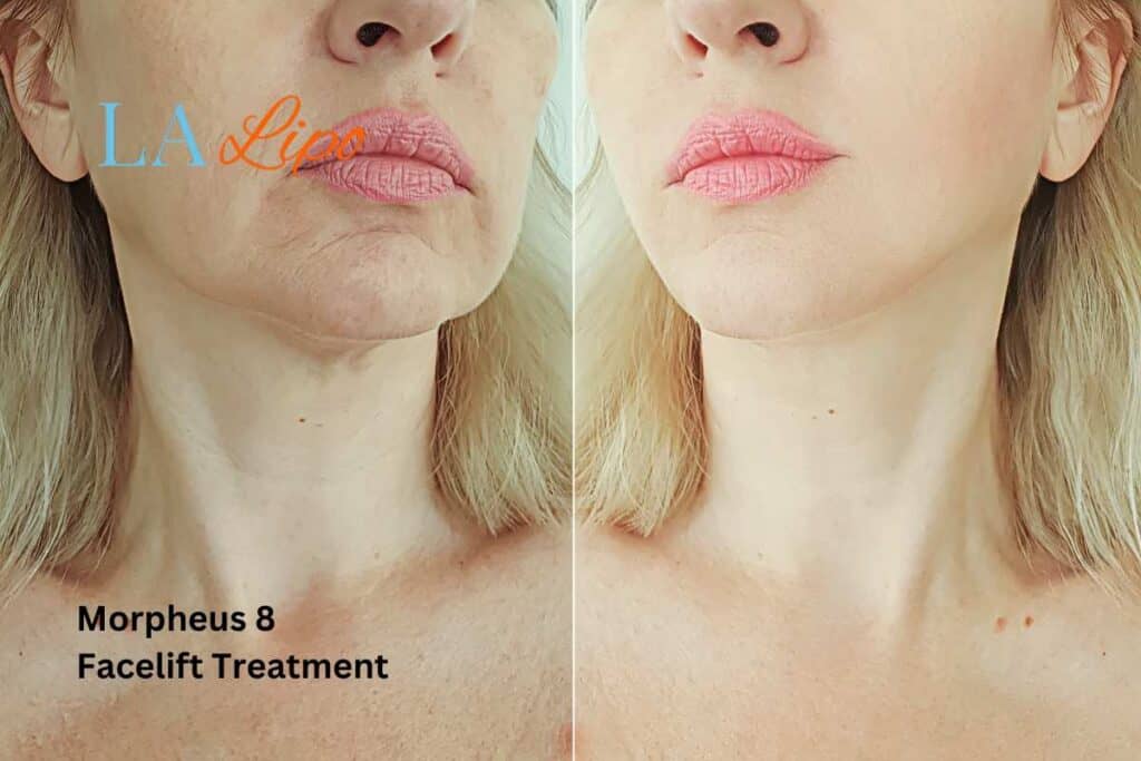 Turn back time with Morpheus8 Treatment Gloucester