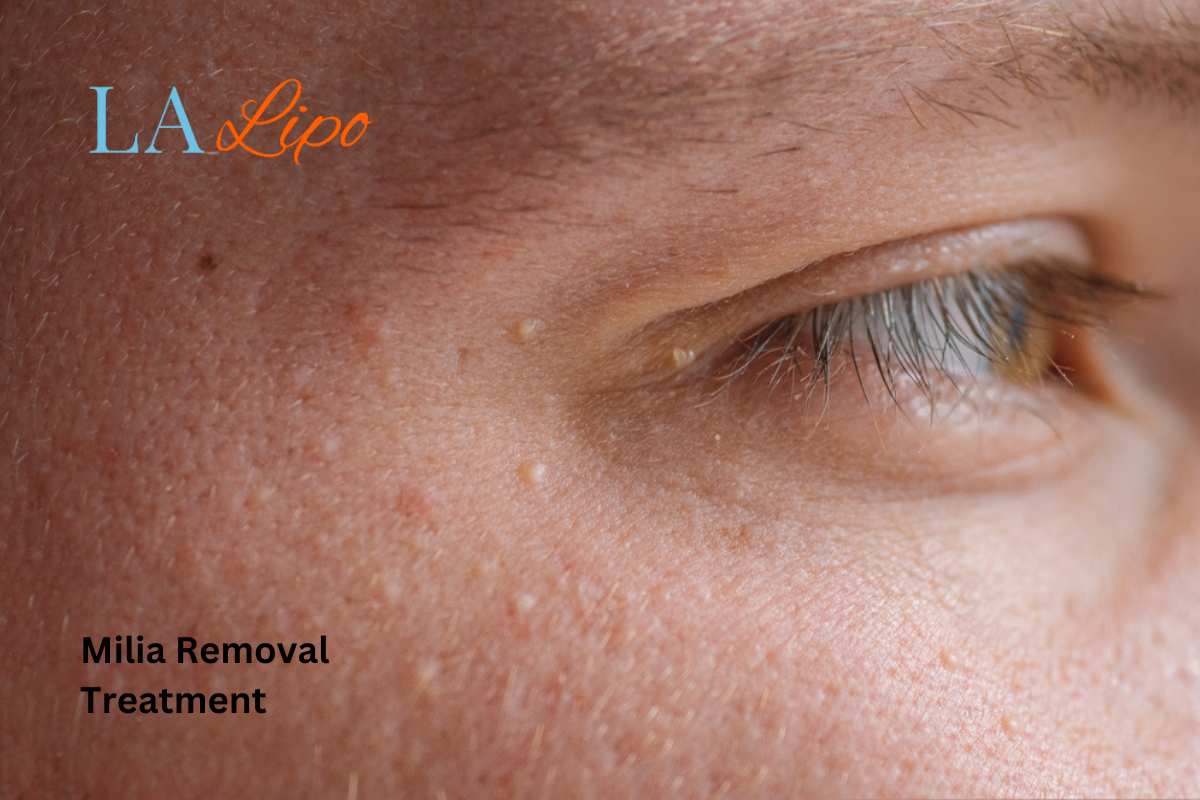 Cryopen Milia Removal: Is It the Easiest and Safest Option Gloucester?
