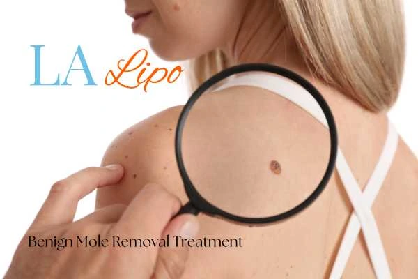 Woman having her inspection of blemish before mole removal Gloucester