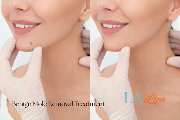 woman's before and after mole removal Gloucester results