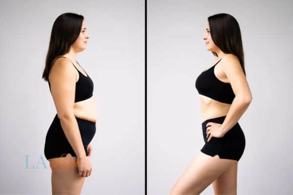 LA-EMS Body Sculpting Gloucester results before and after of womans results on body toning.