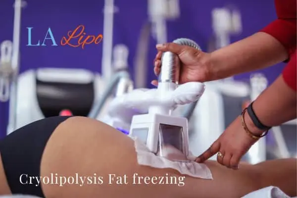 women getting fat freezing Gloucester