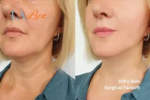hi-fu for wrinkles Gloucester before and after results