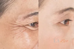 Before and after results of woman - HI-fu wrinkles reduction treatment Gloucester