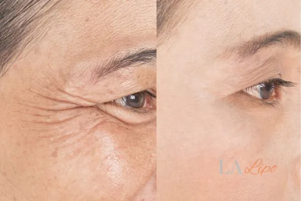 Before and after results of woman - HI-fu wrinkles reduction treatment Gloucester