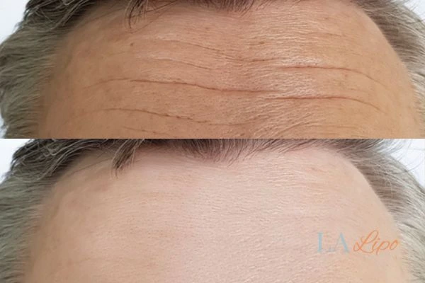 results of HIFU Gloucester on mans forehead to help reduce lines and wrinkles
