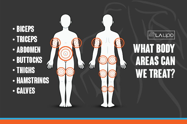 Graphic to show areas you can have LA-EMS Body Sculpting Gloucester treatment.