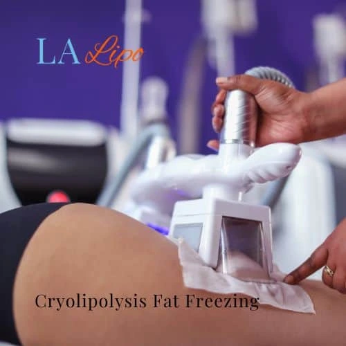 fat freezing - Cryolipolysis Gloucester