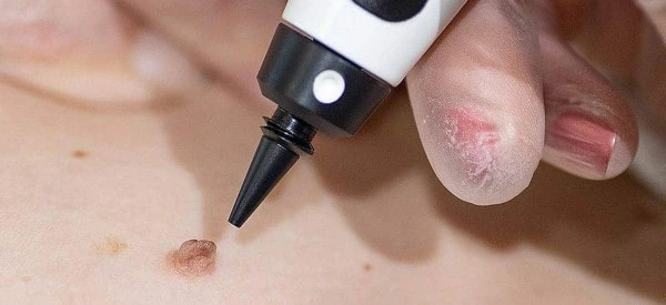skin tag removal using cryopen Gloucester