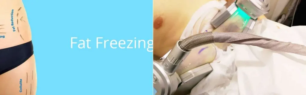 multi areas of a persons body having coolsculpting Gloucester treatment