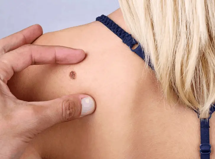 woman having mole removal Gloucester consultation before treatment.