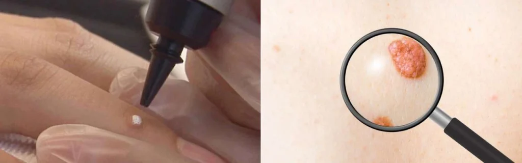Person getting moles removed with cryopen Gloucester