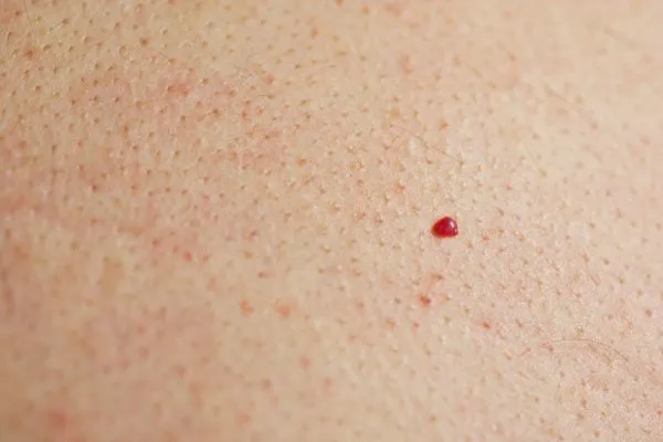 close up of a cherry angioma Gloucester