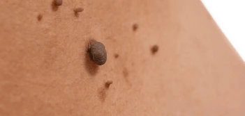 image of a skin tag Gloucester