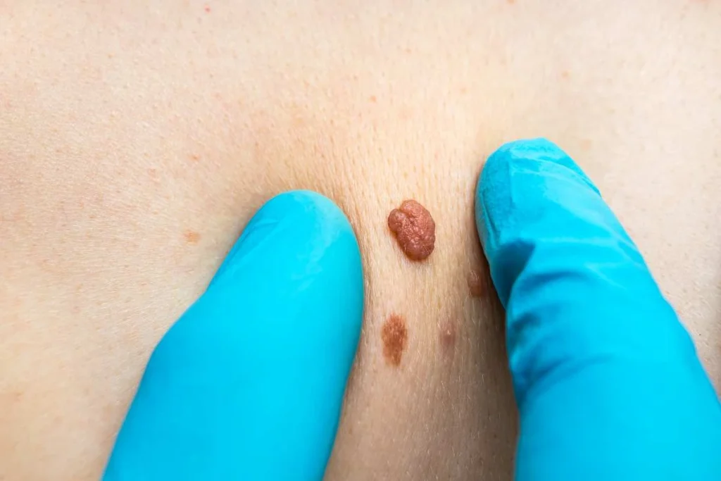 Consultant examining a skin tag Gloucester