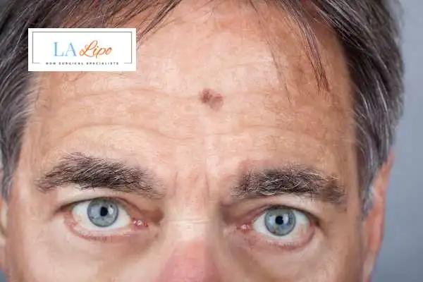 Solar Lentigo Removal Gloucester image of man with mark on his forehead