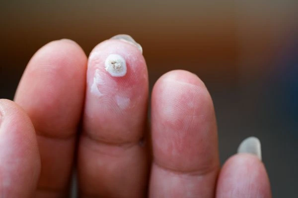 wart on person finger - cryotherapy to treat from LA LIPO Gloucester