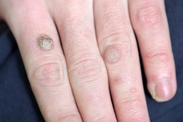 photo of warts on person hand - see wart removal Gloucester from LA LIPO