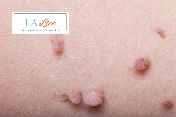 Does cryopen skin tag removal Gloucester hurt? Find out now call our team today!