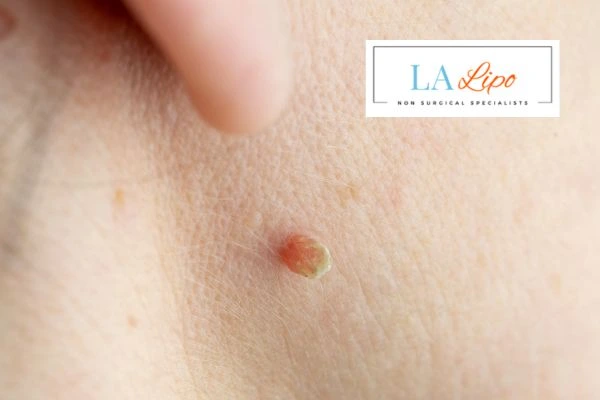 Book skin tag removal Gloucester today speak to our team now!
