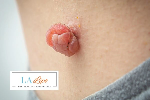 Interested in skin tag removal Gloucester? Concerned about the pain? Find out more today!