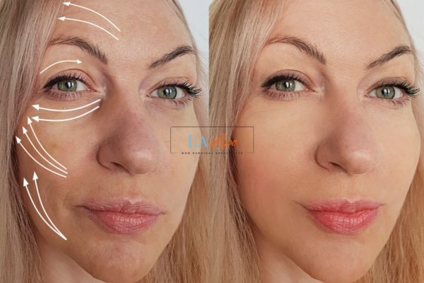 Morpheus 8 results Gloucester face lift.