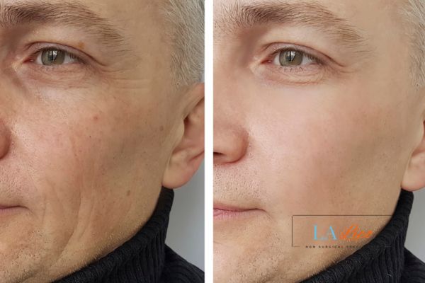 See the amazing results of Morpheus8 Treatment Gloucester!