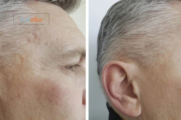 Mens Before & After Morpheus 8 Results Gloucester