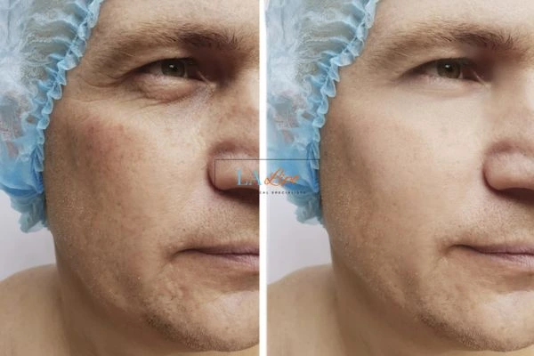 Before and after Morpheus 8 Results Gloucester