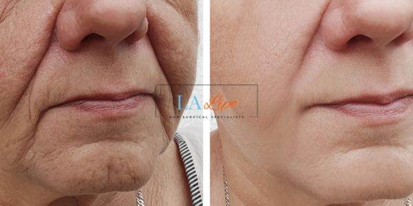 Older lady deeper wrinkle reduction - LA LIPO Morpheus 8 Results Gloucester