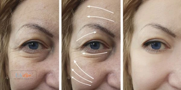 Amazing eye lift Morpheus 8 results Gloucester