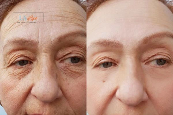 The powerful benefits of Morpheus8 Treatment Gloucester - Call Our team today!