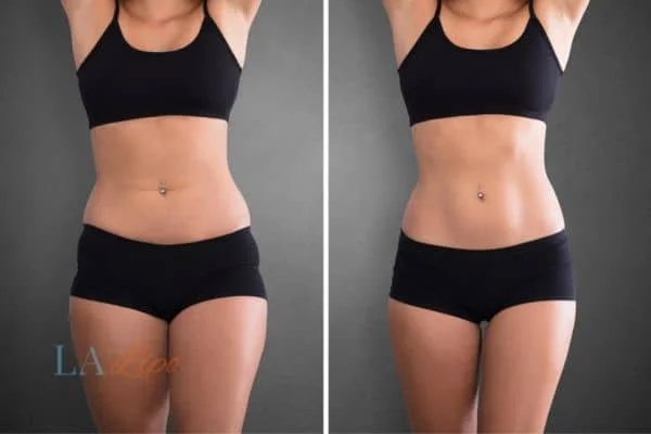 before and after results of non-surgical treatment to help a woman's body image and mental health Gloucester