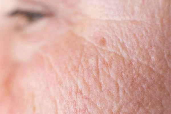 close up picture of a woman's face showing an age spot Gloucester