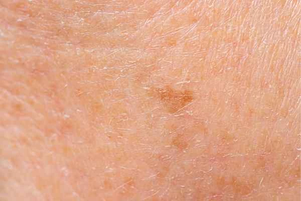 close up picture of age spots Gloucester