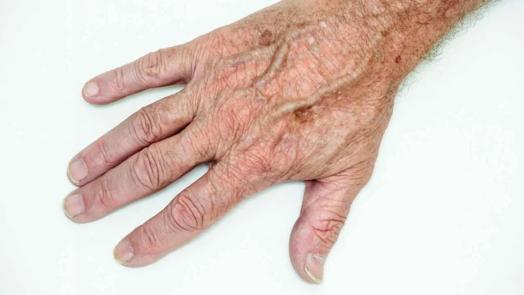 Male hand showing age spot Gloucester