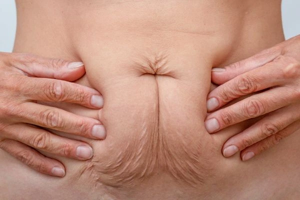 Image of a woman's stomach with loose skin - example of skin tightening Gloucester options