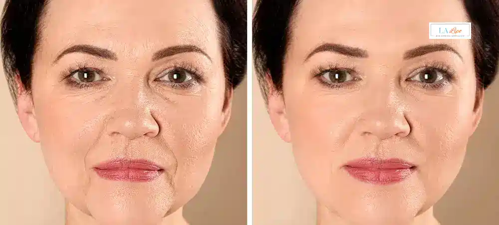 How Long Does It Take to See Results and How Long Do They Last Gloucester?